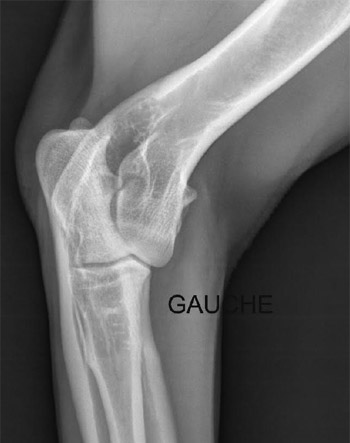 Radiographie du coude